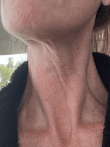 Hello, Crepey Neck